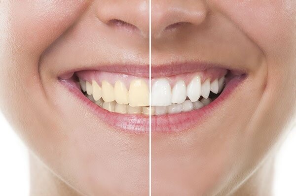 रोजाना दांतों की सफाई करने के बाद भी क्यों रह जाते हैं दांत पीले? जानिए कारण 3