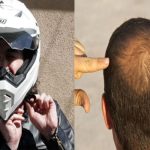 Helmet and Hair Loss