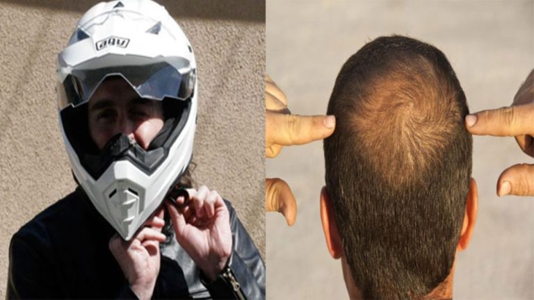 Helmet and Hair Loss