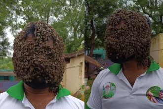 Bees made their home on the face of a young man