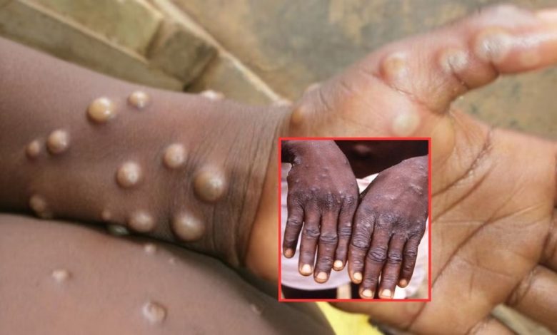 Monkeypox Virus