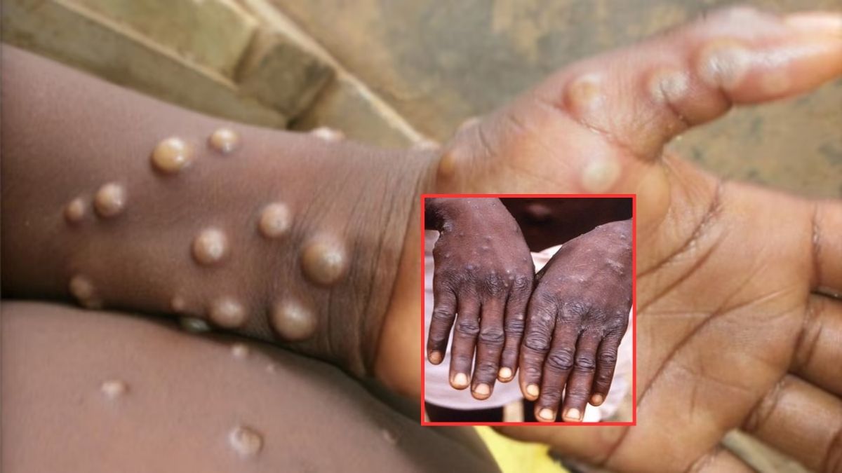 Monkeypox Virus